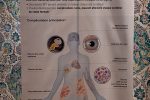 Neurofibromatose de type 1 (NF1) : une maladie génétique rare aux expressions multiples